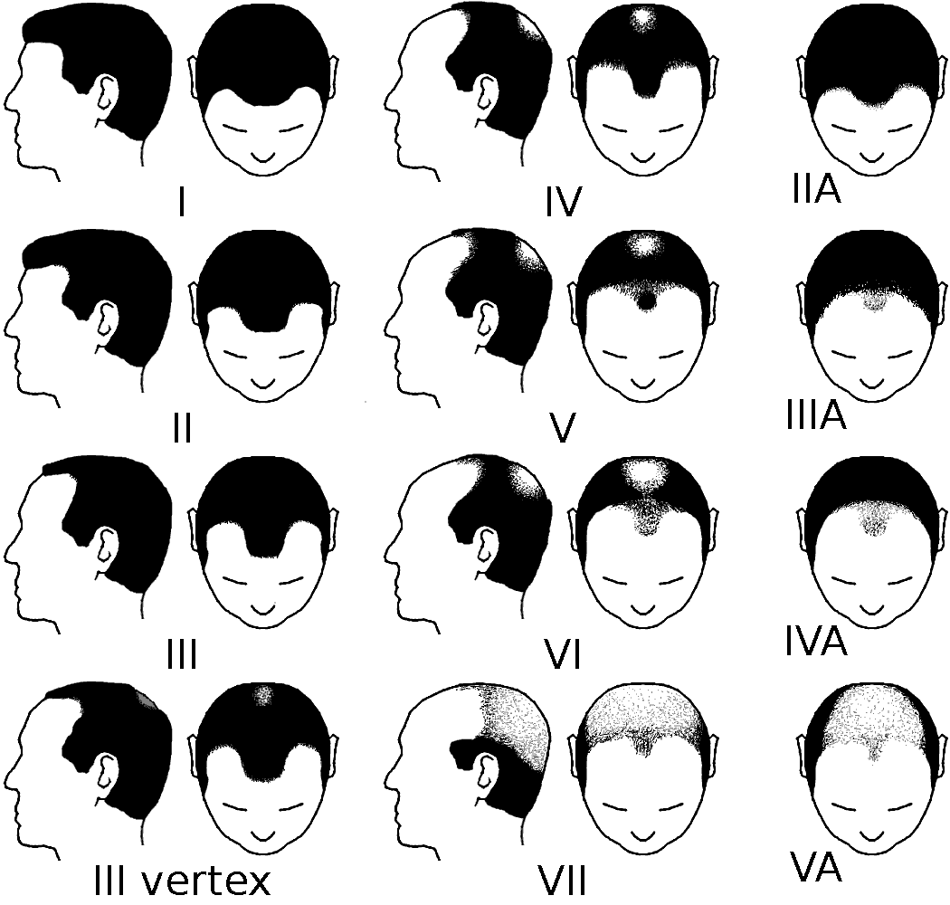 Norwood scale diagram showing the two dominant patterns of male hair loss: recession at the temples and thinning at the crown.